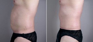 New Jersey Abdominoplasty for Men Image