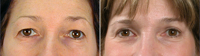 What are the costs of eyelid surgery?
