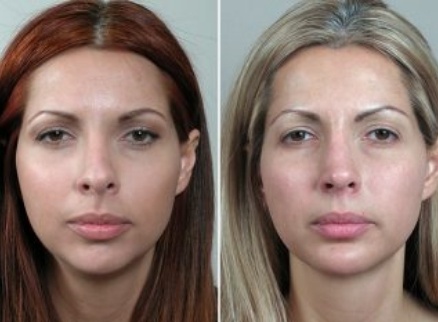 Facial plastic surgery before and after patient photo