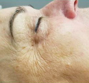 Rezenerate crows feet after