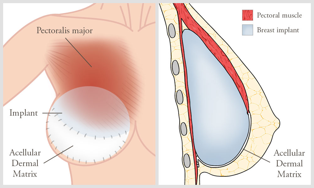 Acellular dermal matrix reinforcing the lower breast