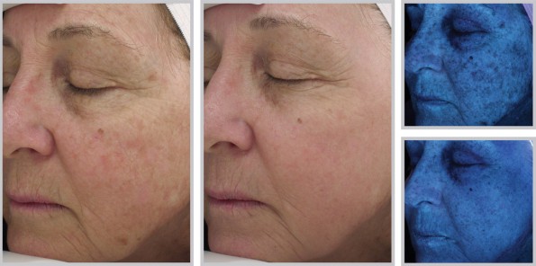 Woman\'s face before and after Halo fractional laser treatment