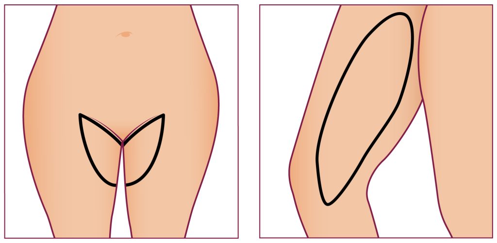 Inner Thigh Lift Illustration