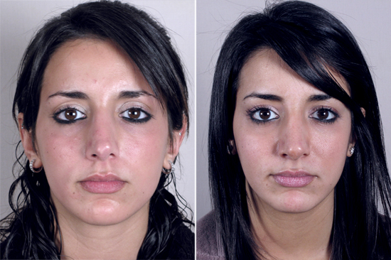 Front view of young female before and after rhinoplasty