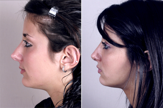 Side view of young female before and after rhinoplasty