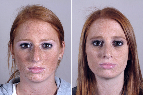 Front view of woman before and after rhinoplasty