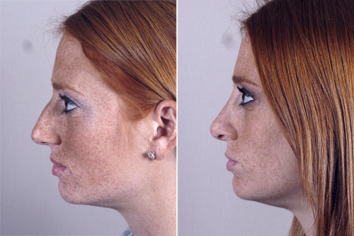 Side view of woman before and after rhinoplasty