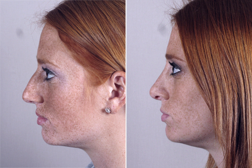 Side view of woman before and after rhinoplasty