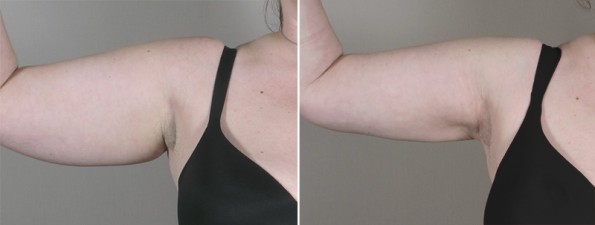 New Jersey Arm Lift