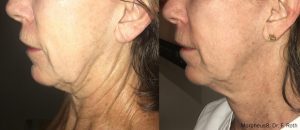 Side view of woman\'s neck and jawline before and after Morpheus8