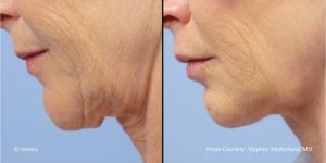 Side view of woman\'s neck before and after Facetite