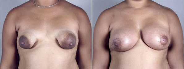 Front view of woman\'s chest before and after tubular breast surgery