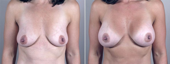 Front view of woman\'s chest before and after breast enlargement