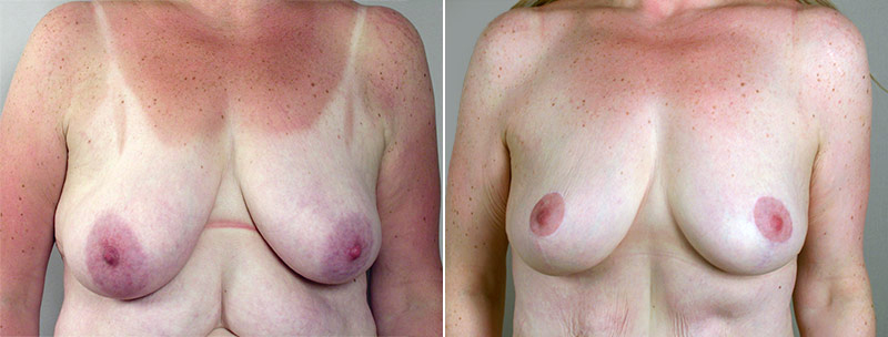 Front view of woman\'s chest before and after breast lift surgery