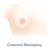 Crescent mastopexy incision pattern