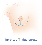 Inverted T breast lift incision pattern