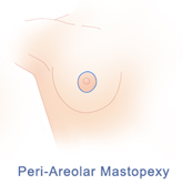 Periareolar mastopexy incision pattern