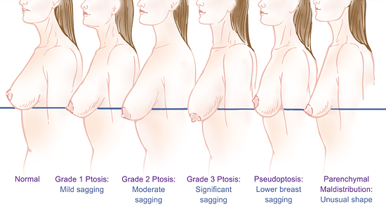 Diagram showing grades of breast ptosis