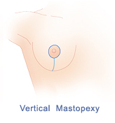 Vertical mastopexy incision pattern