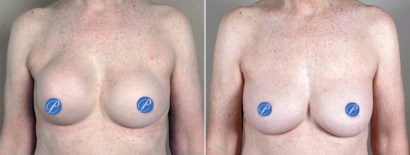 Woman's chest before and after treatment for capsular contracture