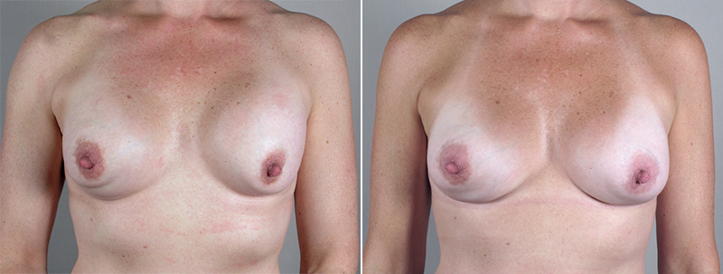 Front view of woman\'s chest before and after breast implant revision