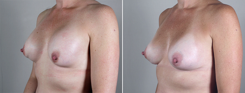 Side view of woman\'s chest before and after breast implant revision surgery