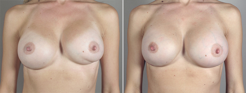 Woman\'s chest before and after breast implant revision surgery