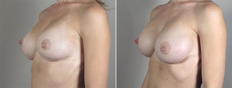 Side view of woman\'s chest before and after breast implant revision surgery