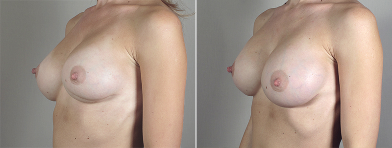 Side view of woman\'s chest before and after breast revision surgery