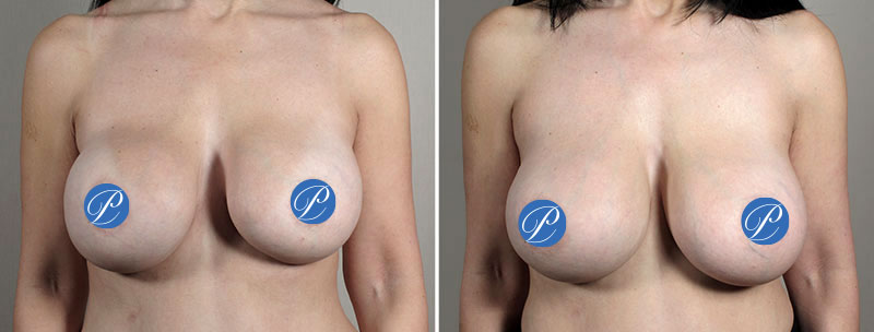 Woman's chest before and after treatment for capsular contracture