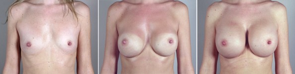 Woman\'s chest before breast augmentation, with unsatisfactory result, and after revision surgery