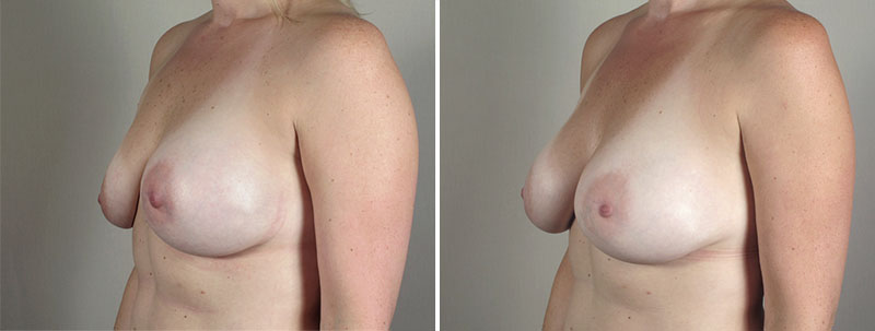 Side view of woman\'s chest before and after breast implant revision