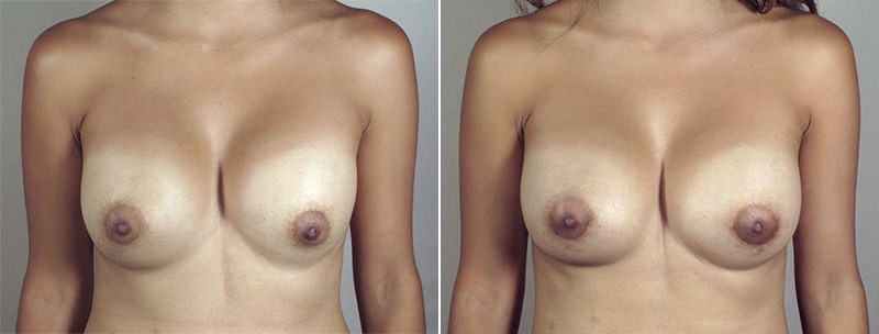 Woman\'s chest before and after breast implant revision surgery