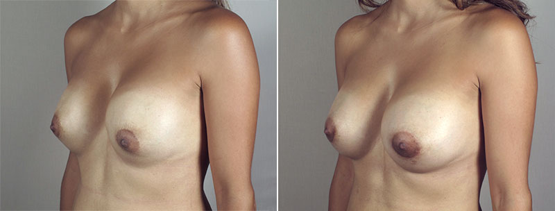 Side view of woman\'s chest before and after breast implant revision surgery