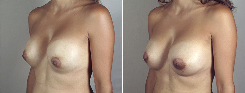 Side view of woman\'s chest before and after breast implant revision