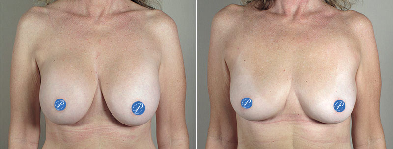 Before & After: Breast Implant Removal (Explantation)