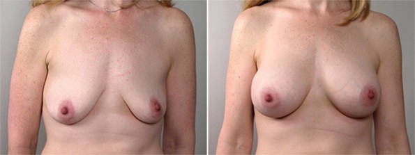 Front view of woman\'s chest before and after breast lift surgery