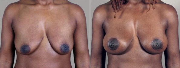 Front view of woman\'s chest before and after breast surgery