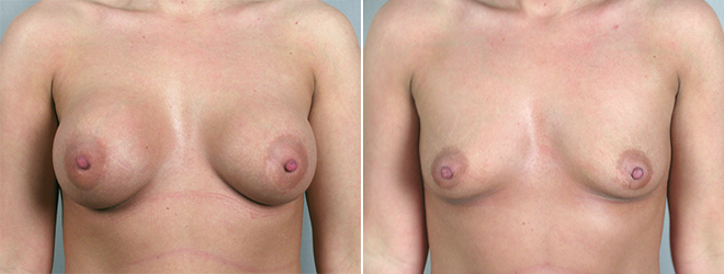 Front view of woman\'s chest before and after breast implant removal