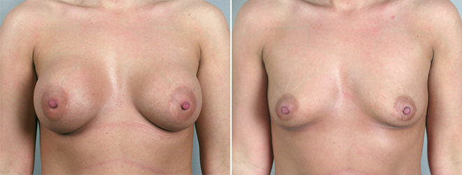 Woman\'s chest before and after breast implant removal