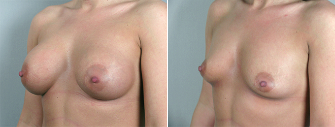 Side view of woman\'s chest before and after breast implant removal
