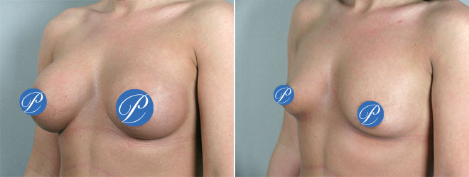 Before & After: Breast Implant Removal (Explantation)