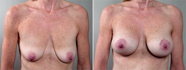 Front view of woman\'s chest before and after breast lift