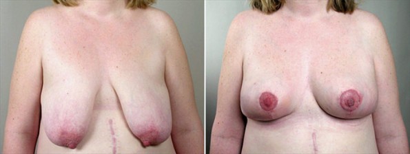 Front view of woman\'s chest before and after breast lift surgery
