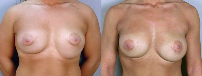Front view of woman\'s chest before and after breast implant revision