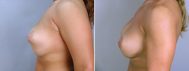 Side view of woman\'s chest before and after breast implant revision surgery