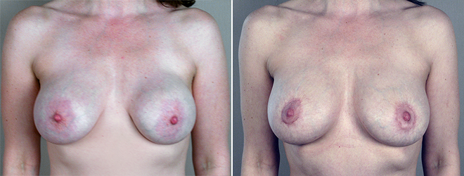 Woman\'s chest before and after breast implant revision surgery