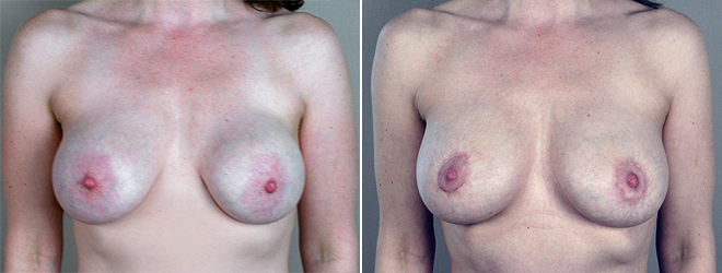 Front view of woman\'s chest before and after breast revision surgery