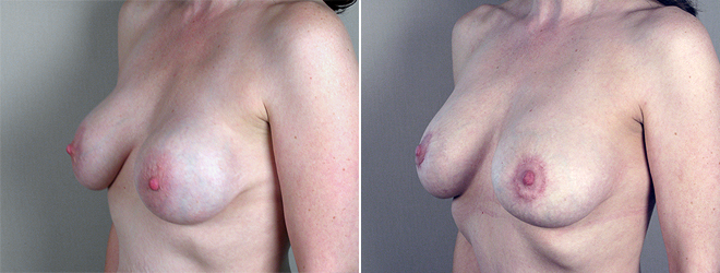 Side view of woman\'s chest before and after breast implant revision surgery