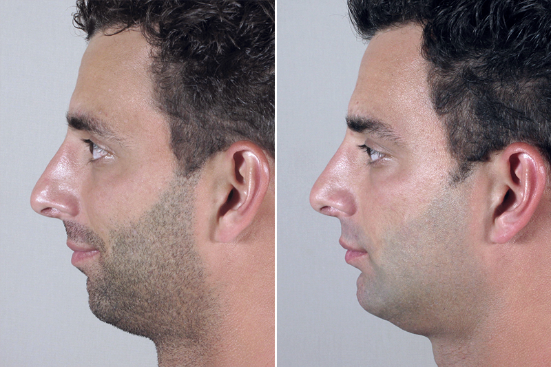 Chin Augmentation for Men Before and After